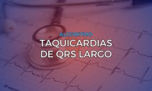 Leia mais sobre o artigo Algoritmos para Diagnóstico Diferencial nas Taquicardias de QRS Largo