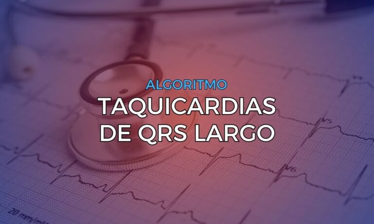 Leia mais sobre o artigo Algoritmos para Diagnóstico Diferencial nas Taquicardias de QRS Largo