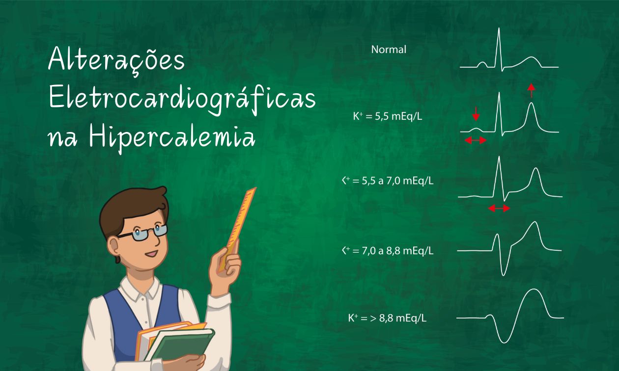 No momento, você está visualizando Hipercalemia e suas Alterações Eletrocardiográficas: Como o ECG Reflete os Níveis Sérios de Potássio