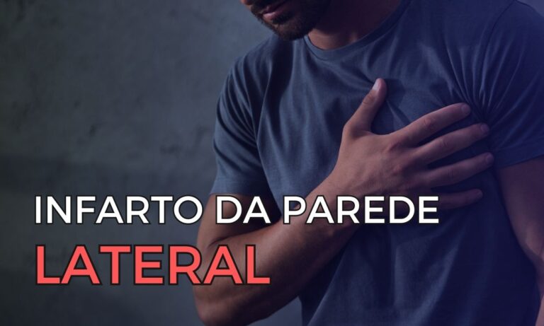 Leia mais sobre o artigo Identificando o Infarto da Parede Lateral: O Papel do ECG nas Oclusões da Circunflexa