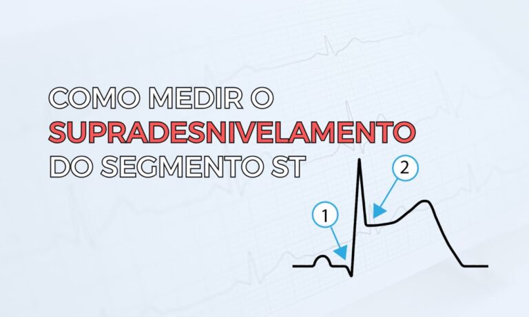 Leia mais sobre o artigo Como Medir o Supradesnivelamento do Segmento ST no ECG
