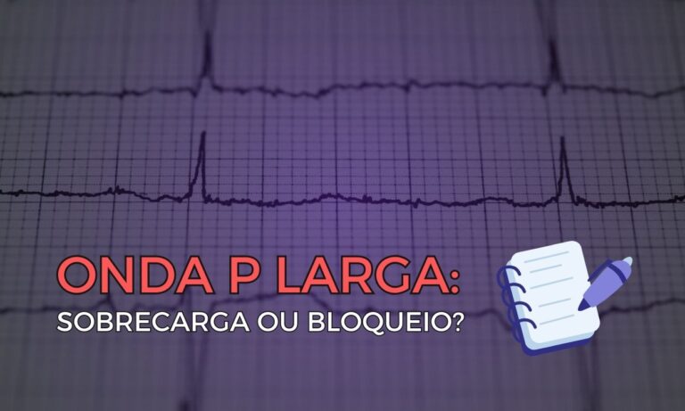 Leia mais sobre o artigo Onda P Larga: Sobrecarga ou Bloqueio?