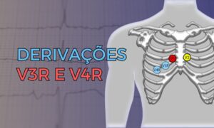 Leia mais sobre o artigo V3R e V4R: Quando utilizá-las e qual o seu papel no diagnóstico de infarto