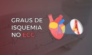 Leia mais sobre o artigo Graus de Isquemia no Eletrocardiograma