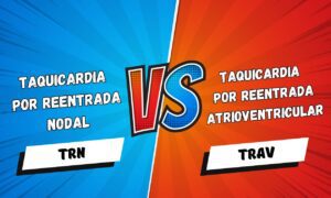 Leia mais sobre o artigo Taquicardia por Reentrada Nodal vs Taquicardia por Reentrada Atrioventricular Ortodrômica