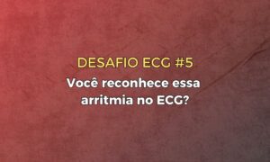 Leia mais sobre o artigo Desafio ECG #5 – Você reconhece essa arritmia no ECG?