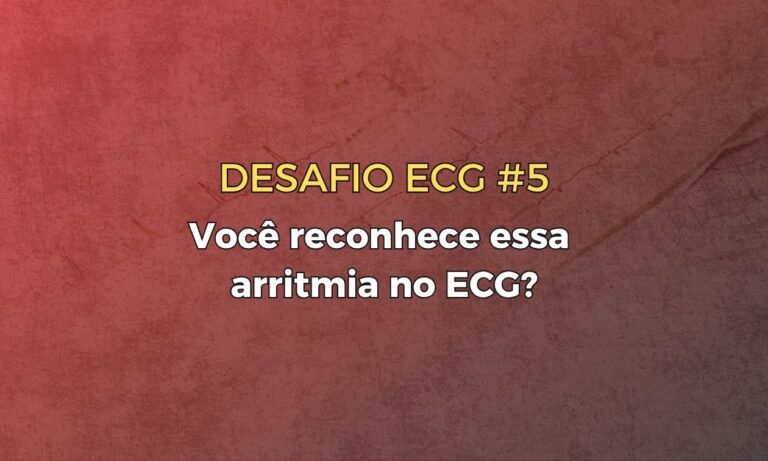 Leia mais sobre o artigo Desafio ECG #5 – Você reconhece essa arritmia no ECG?