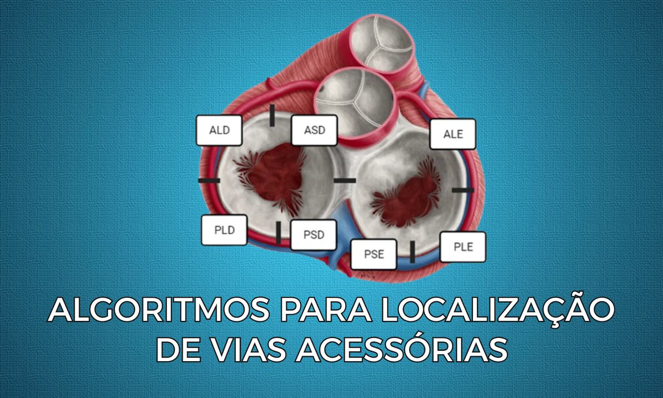 No momento, você está visualizando Algoritmos para Localização de Vias Acessórias: Entenda, Compare e Conheça o EPM